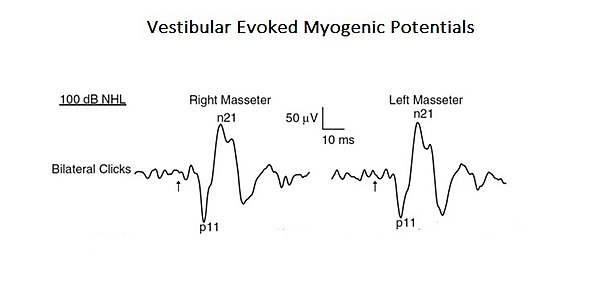 Abbildung 1: Vestibula evozierte myogene Potenziale (siehe Kapitel „Komplexe Systeme“)