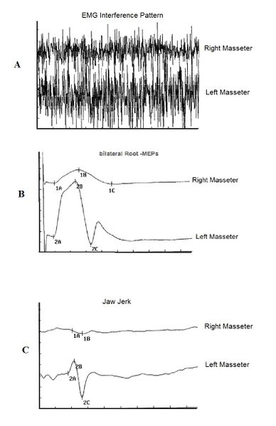 Figure 2:Trigeminal electrophysiological responses.