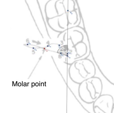 Figura 3: Rappresentazione delle distanze tra punti nel molare ipsilaterale alla laterotrusione