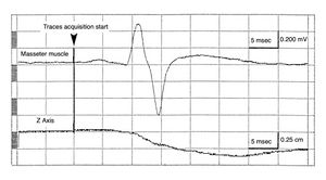 Sirignathograph e jaw jerk 1.jpg