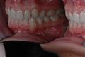 Final left view of Invisible OrthoNeuroGnathodontic treatments (mirror).jpg