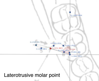 Figura 3: Rappresentazione delle distanze tra punti nel molare ipsilaterale alla laterotrusione