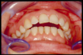 Frontal Occlusal view in TMDs patient with Postpolio Syndrome.png