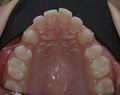 Occlusal view of Invisible OrthoNeuroGnathodontic treatments.jpg