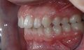 Invisible OrthoNeuroGnathodontic before treatments (left side).jpg