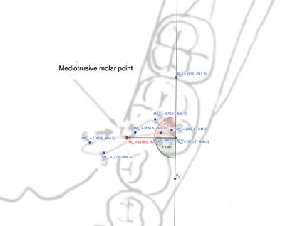 Figura 4: Distanze tra i punti mediotrusivi molari