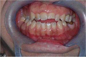 Occlusal Centric view in open and cross bite patient.jpg
