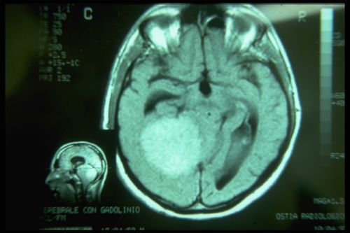 Meningioma 5 by Gianni Frisardi.jpg